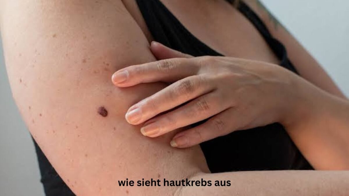wie sieht hautkrebs aus wie sieht hautkrebs aus